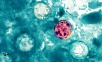 Cyclospora hits more than 170 in Midwest