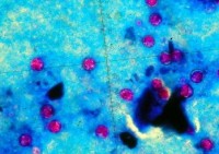 Cyclospora outbreak in Midwestern states grows to 267 with more cases in Iowa